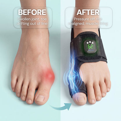 Kadvio's EMS Bunion Corrector